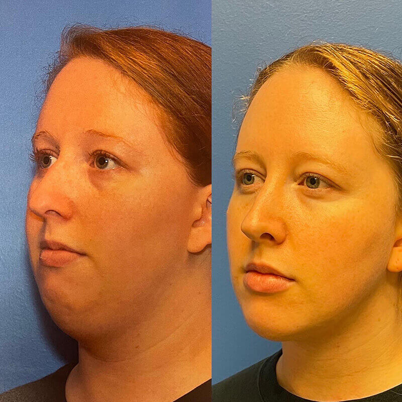 Neck Contouring Before and After Patient 4