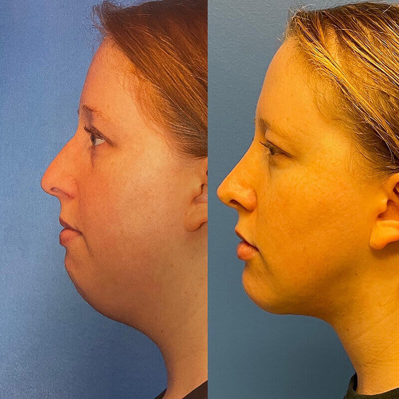 Neck Contouring Before and After Patient 5