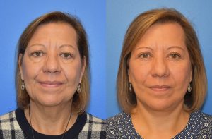 Facelift & Neck Lift Before and After Patient Thumbnail 1