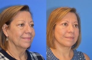 Facelift & Neck Lift Before and After Patient Thumbnail 2