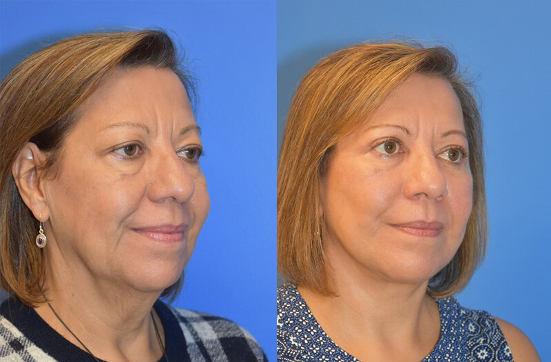 Facelift & Neck Lift Before and After Patient 2