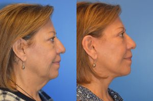 Facelift & Neck Lift Before and After Patient Thumbnail 3