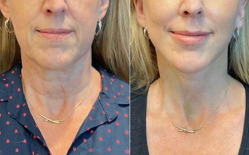 Facelift & Neck Lift Before and After Patient 1