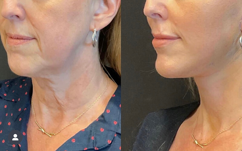Facelift & Neck Lift Before and After Patient 2