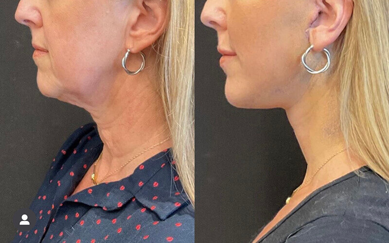 Facelift & Neck Lift Before and After Patient 3