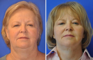 Facelift & Neck Lift Before and After Patient Thumbnail 2