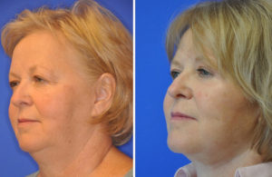 Facelift & Neck Lift Before and After Patient Thumbnail 3