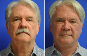 Facelift & Neck Lift Before and After Patient Thumbnail 2