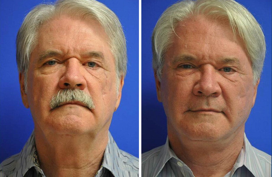 Facelift & Neck Lift Before and After Patient 2