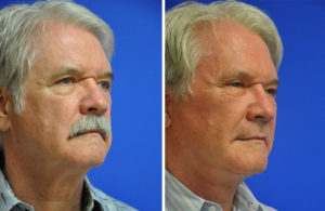 Facelift & Neck Lift Before and After Patient Thumbnail 3