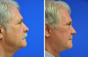 Facelift & Neck Lift Before and After Patient Thumbnail 1