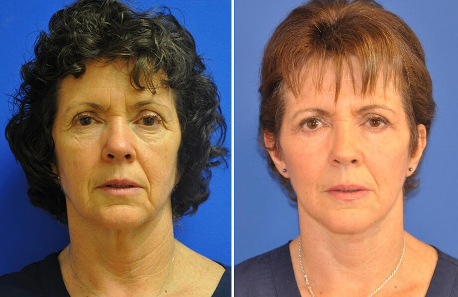 Facelift & Neck Lift Before and After Patient 2
