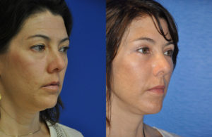 Facelift & Neck Lift Before and After Patient Thumbnail 3