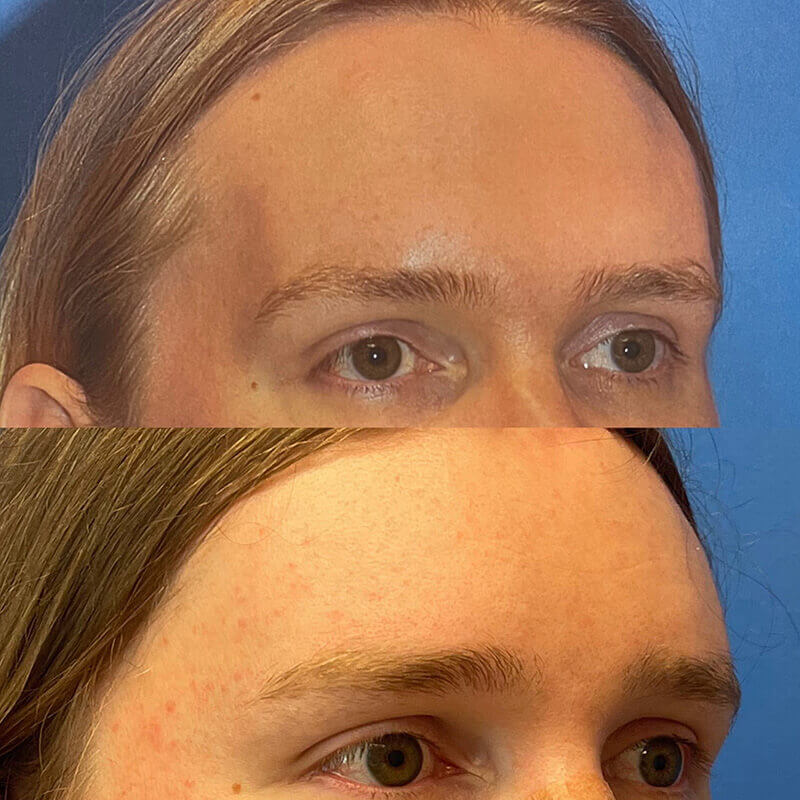 Facial Feminization Before and After Patient 1