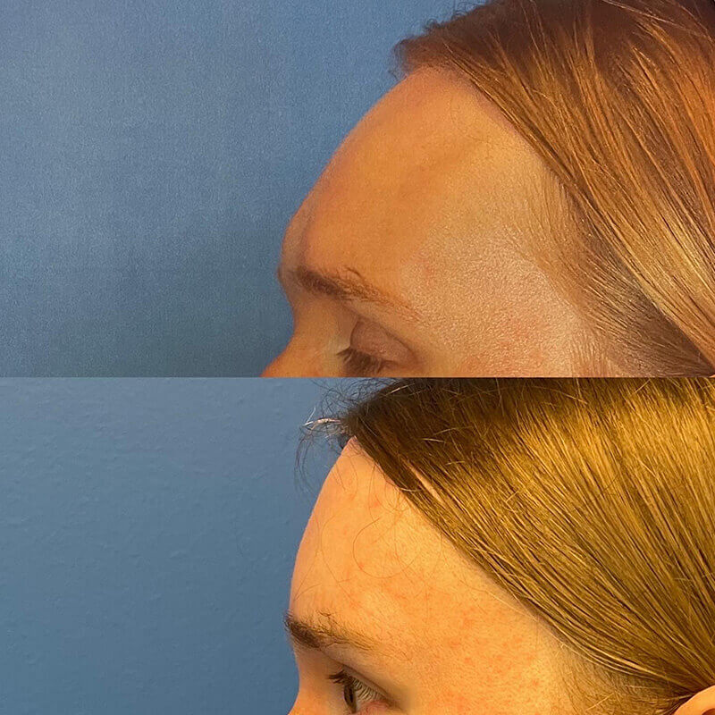 Facial Feminization Before and After Patient 2