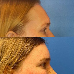 Facial Feminization Before and After Patient Thumbnail 3
