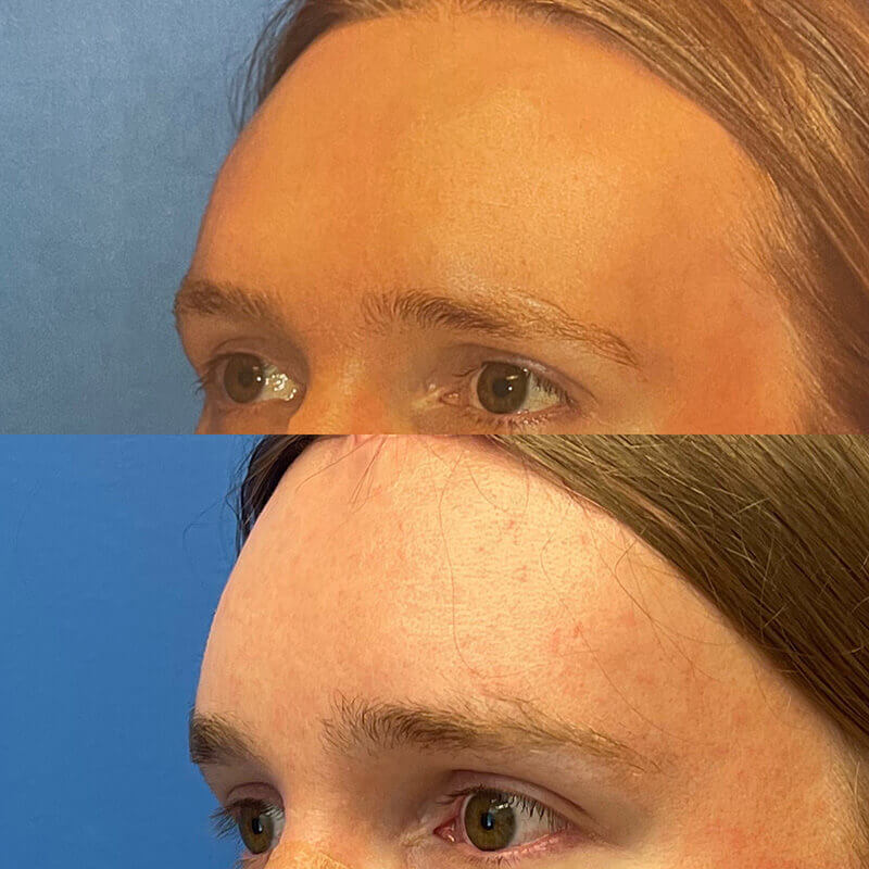 Facial Feminization Before and After Patient 5