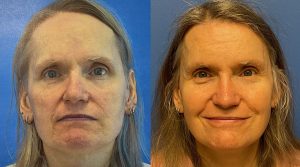 Facial Feminization Before and After Patient Thumbnail 1