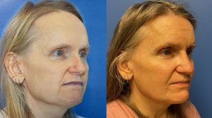 Facial Feminization Before and After Patient Thumbnail 2