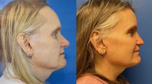 Facial Feminization Before and After Patient Thumbnail 3