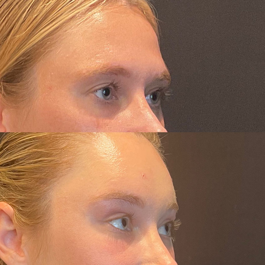 Facial Rejuvenation Before and After Patient 2
