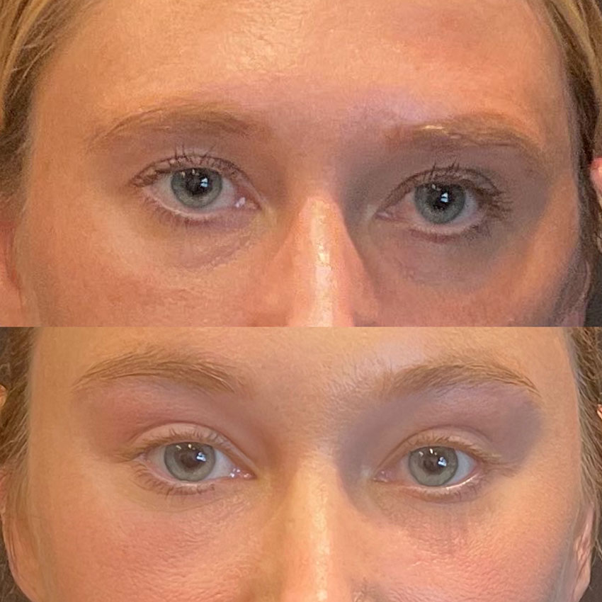 Facial Rejuvenation Before and After Patient 1