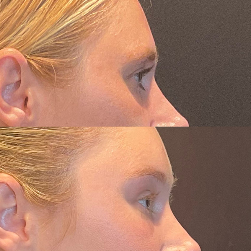 Facial Rejuvenation Before and After Patient 4