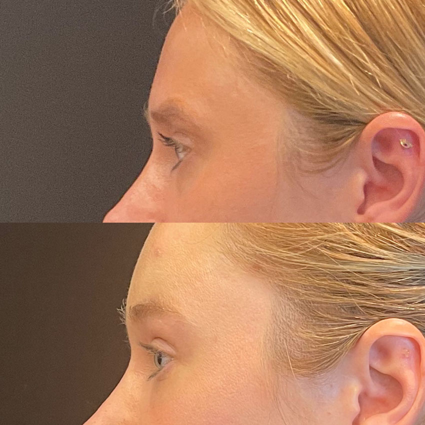 Facial Rejuvenation Before and After Patient 5
