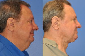 Neck Contouring Before and After Patient Thumbnail 3