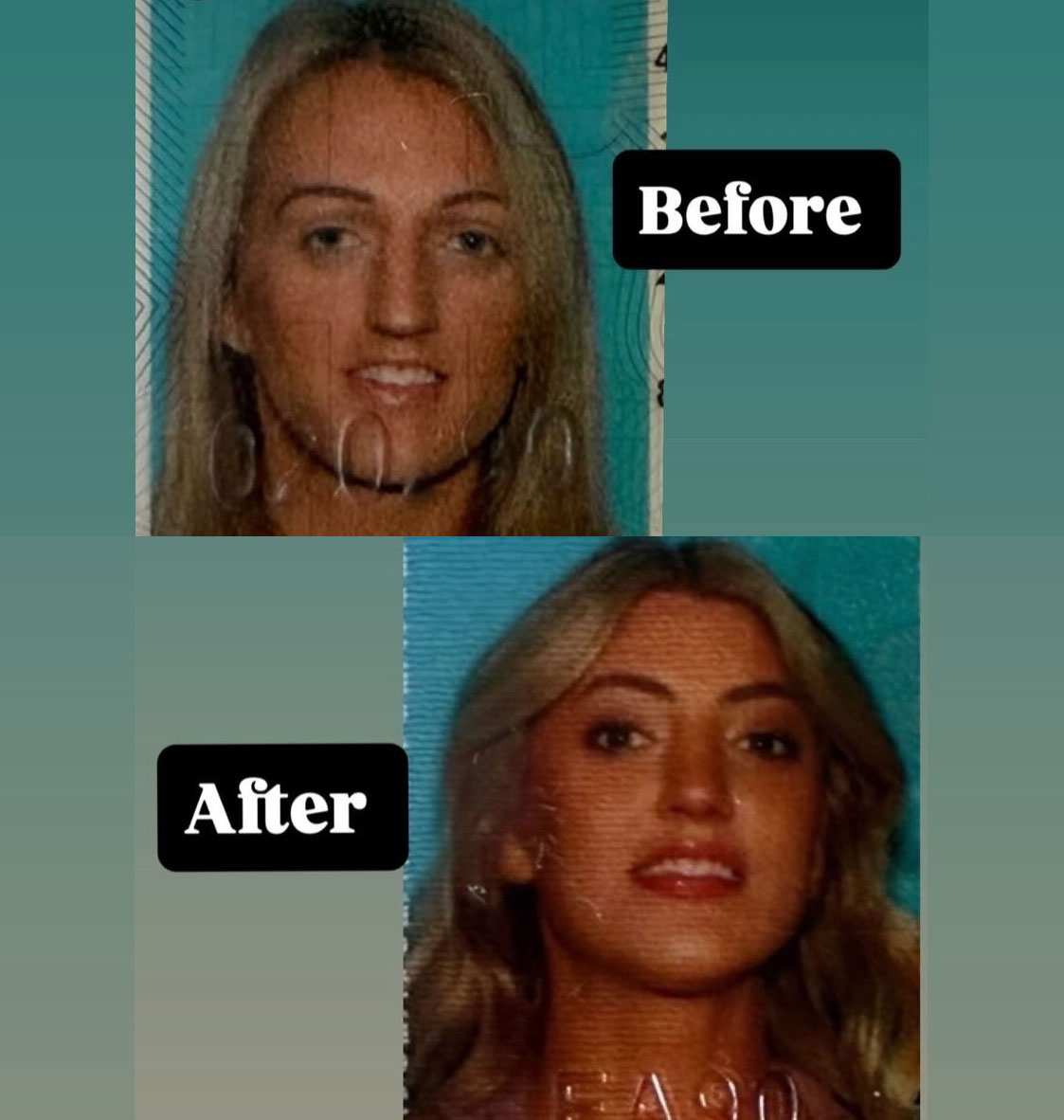 Facial Feminization Before and After Patient 1