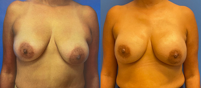 Breast Before and After Patient 1