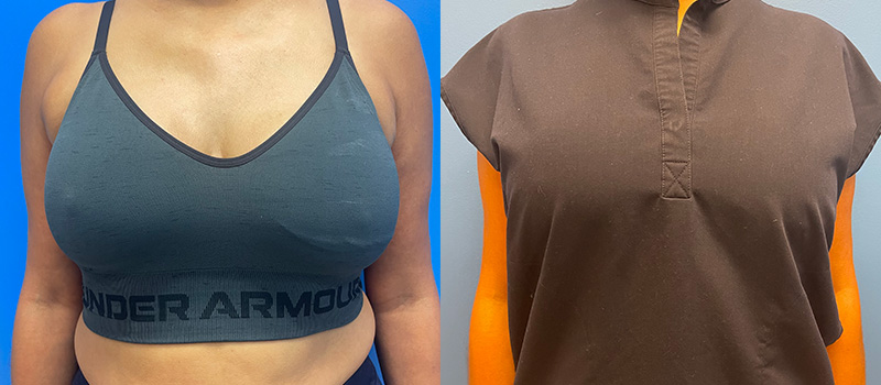 Breast Before and After Patient 2