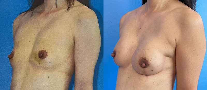 Breast Before and After Patient 3