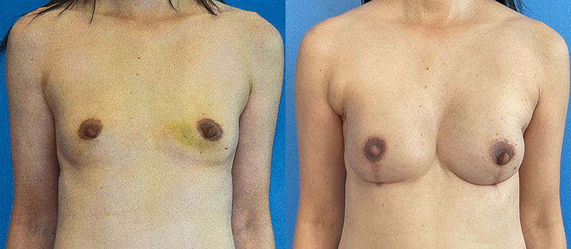 Breast Before and After Patient 1