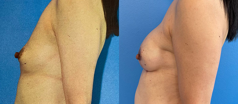 Breast Before and After Patient 2