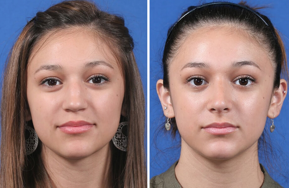 Rhinoplasty Before and After Patient 2