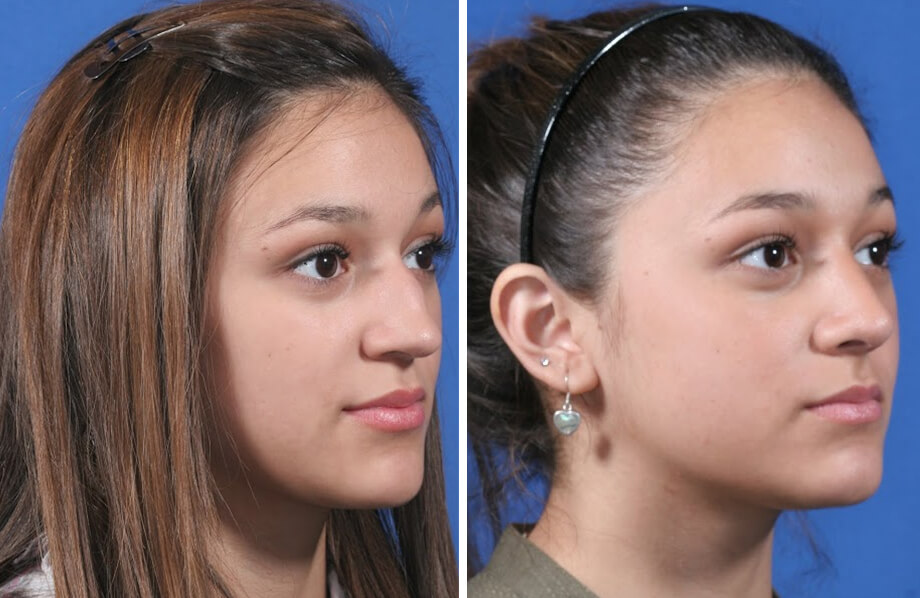 Rhinoplasty Before and After Patient 3