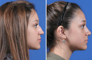 Rhinoplasty Before and After Patient Thumbnail 1