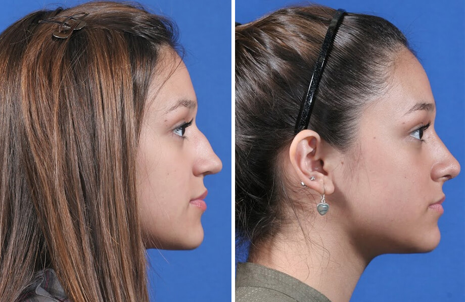 Rhinoplasty Before and After Patient 1