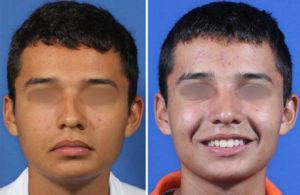 Rhinoplasty Before and After Patient Thumbnail 2