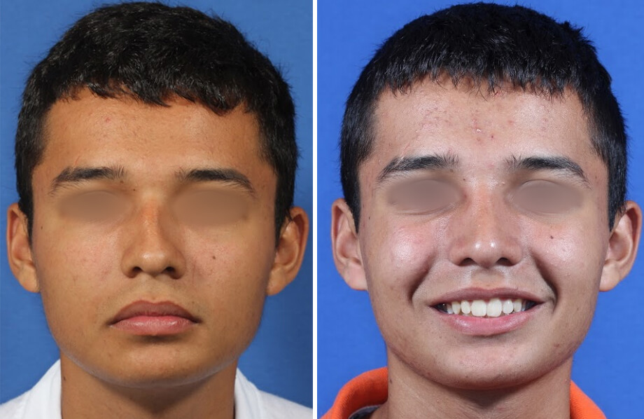 Rhinoplasty Before and After Patient 2