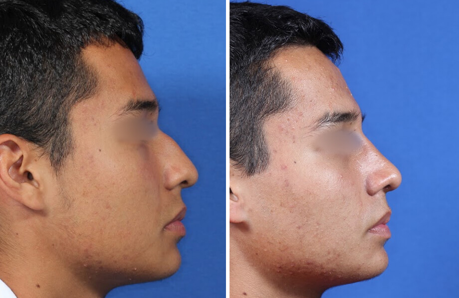 Rhinoplasty Before and After Patient 1
