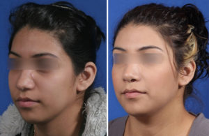Rhinoplasty Before and After Patient Thumbnail 4