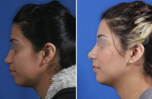 Rhinoplasty Before and After Patient Thumbnail 2