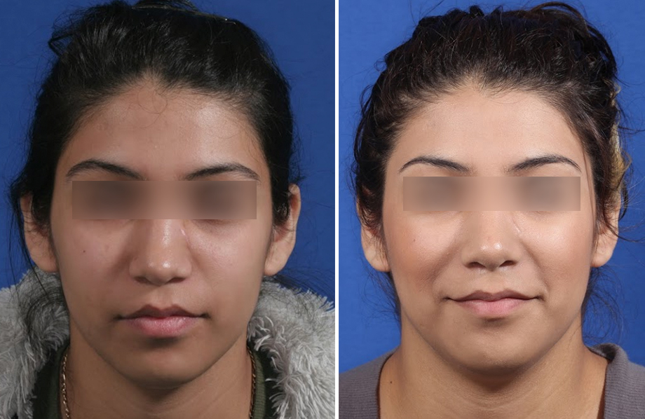 Rhinoplasty Before and After Patient 3