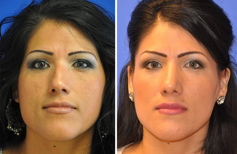 Rhinoplasty Before and After Patient 2