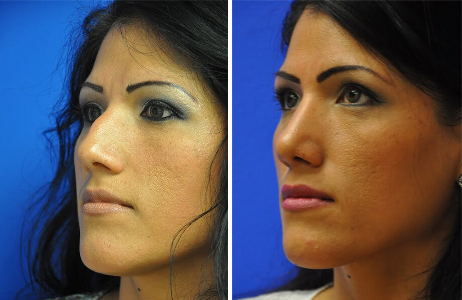 Rhinoplasty Before and After Patient 3