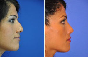 Rhinoplasty Before and After Patient Thumbnail 1