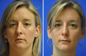 Rhinoplasty Before and After Patient Thumbnail 2