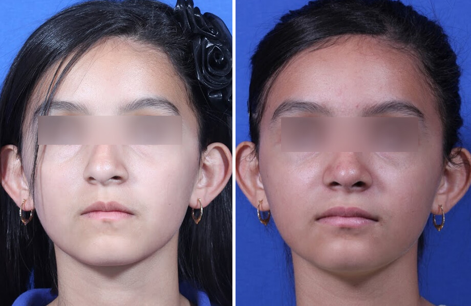 Rhinoplasty Before and After Patient 2